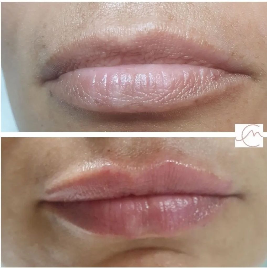 aumento de labios antes y despues