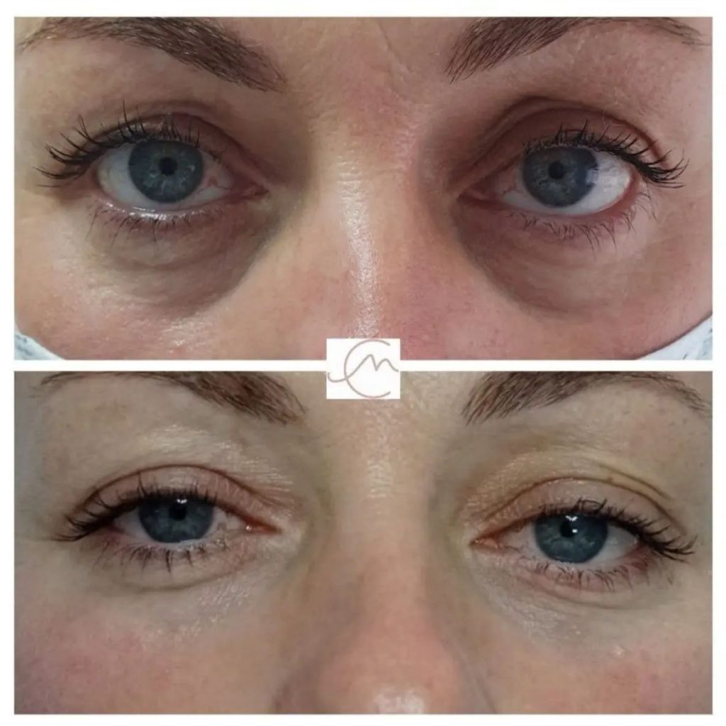 antes y despues tratamiento anti ojeras